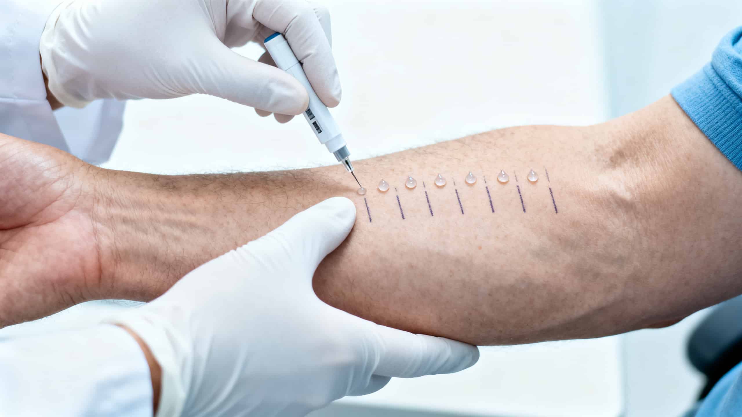Allergologue réalisant des prick-tests cutanés sur l'avant-bras d'un patient