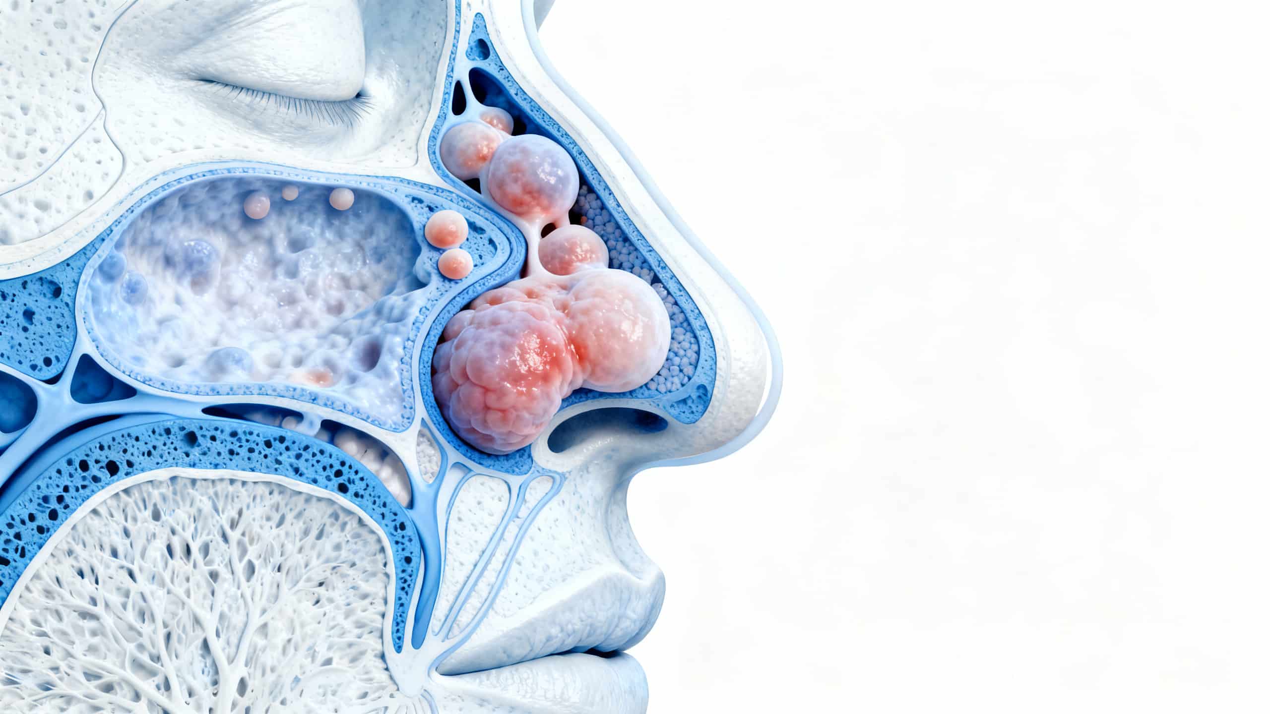 Représentation des fosses nasales avec polypes et inflammation de la muqueuse